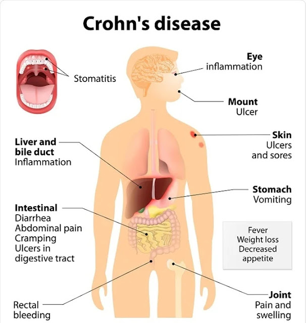 EMS Particular Patient Presentations – Crohn’s Disease