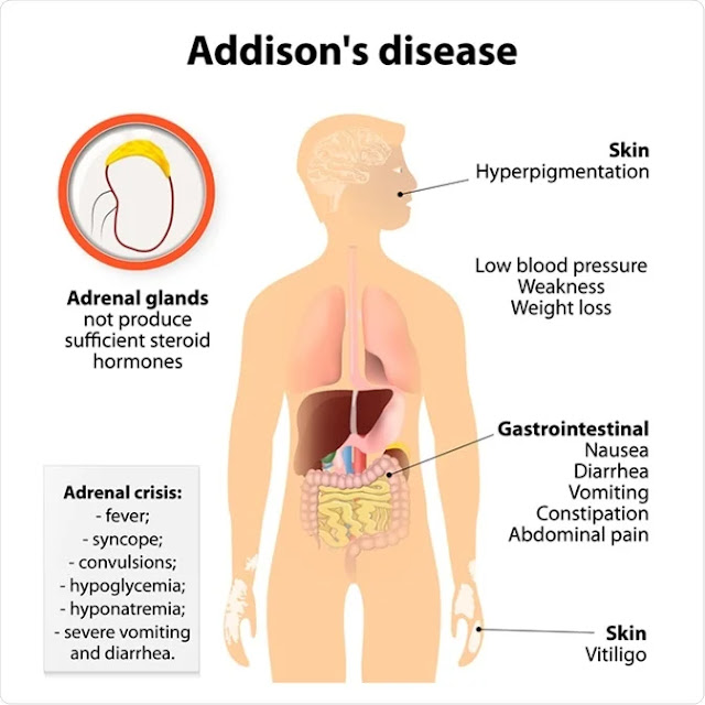EMS Particular Patient Presentations – Addison’s Disease