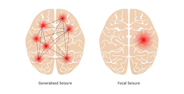 EMS Neurological Emergencies – Seizure Disorder Classification