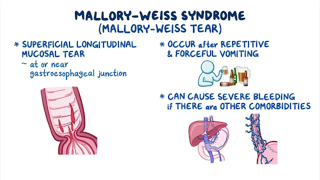 EMS Medical Terminology – Mallory-Weiss Syndrome